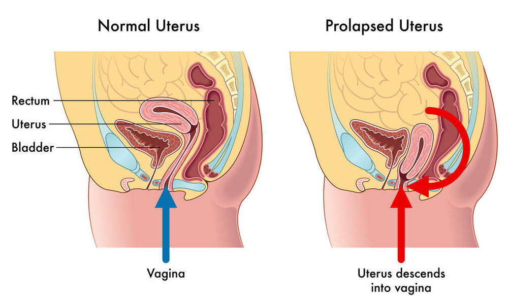 子宫脱垂的常见症状和治疗方法