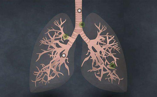慢阻肺为什么会发生营养不良