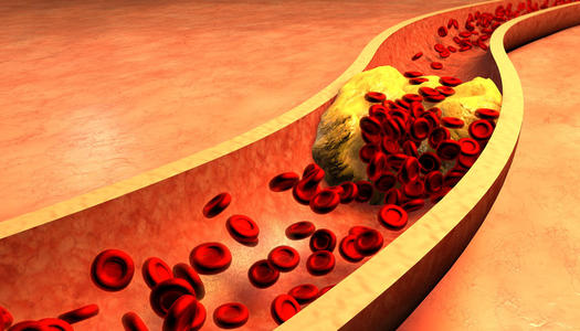 血管中藏有血栓的人，睡觉时，会有3种迹象，若占1个，尽快查一下